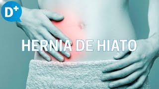 Hernia de hiato: Causas, síntomas y tratamiento de la hernia de hiato