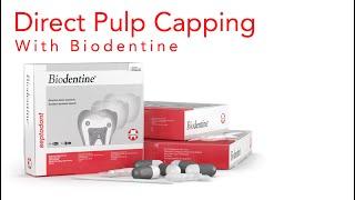 Biodentine Direct Pulp Capping - Improve Pulp Capping Success Rate | Techniques and Material 2022