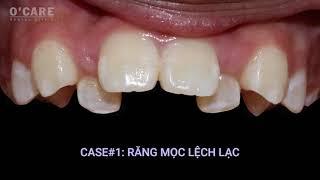 Sự thay đổi của hàm trên khi niềng răng | Upper jaw braces