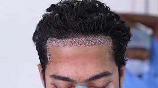 Best Hair Transplant Surgery in INDIA | Richardson Face Hospital