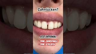 Zahnlücken? Ohne Zahnspange & Schleifen zum Hollywood Smile! #flowableinjection #schönezähne