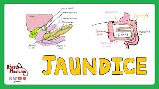 JAUNDICE: Differential diagnosis of Jaundice - Prehepatic/Hepatic/Post Hepatic Causes of Jaundice