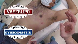 Long Island VaserLipo Center & Gynecomastia Surgery by Dr. Jonathan Lebowitz in Huntington, NY