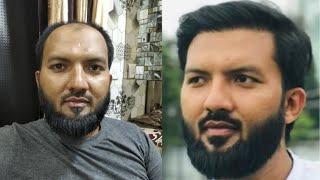 Hair Transplant in Mumbai | Best Hair Transplant Results in Mumbai