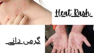 Heat Rash / گرمی دانے | How to use |