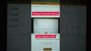 Pacemaker Threshold Testing - Capture Management #bostonscientific #ppm #pacemaker  #heartbeat