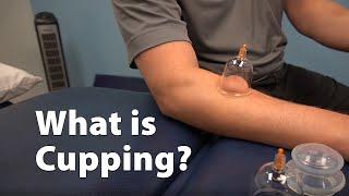 What is Cupping?