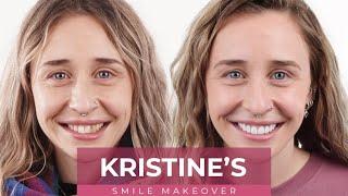 Kristine's Porcelain Veneer Smile Makeover Journey | Dental Boutique