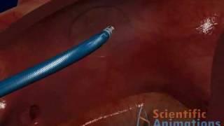 Medical Animation -  Robotic catheter system