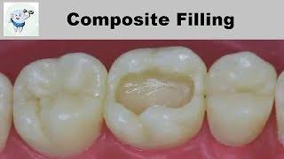 Composite Dental Filling Step by Step