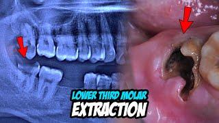 Molar Tooth Extraction Procedure | Dentist | Dokter Gigi Tri Putra