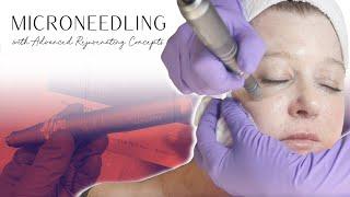 Microneedling Deep Dive and Treatment Demo | Advanced Rejuvenating Concepts