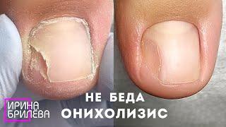 Pedicure WITHOUT PANIC !!!  Onycholysis is not scary  HOW TO GROW a new and healthy nail -Eng SUBS