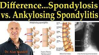 The Difference Between Spondylosis & Ankylosing Spondylitis -  Dr Alan Mandell, DC