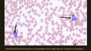 Pediatric Leukemia and lymphoma