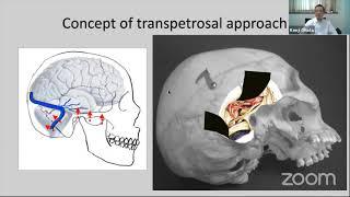 Transpetrosal Approach and Surgery for Petroclival Meningioma- Kenji Ohata