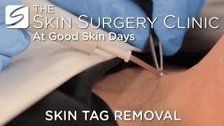 Skin Tag Removal | Watch the Procedure