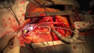 Live Open Heart Surgery in Hospital - Heart Operation Videos