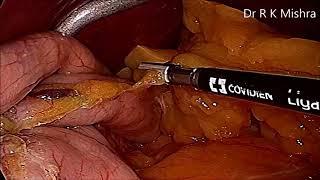 Obesity Surgery - Vertical Sleeve Gastrectomy