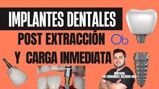 Implantes dentales post extracción y carga inmediata  con Dr Emmanuel Guzmán Ríos