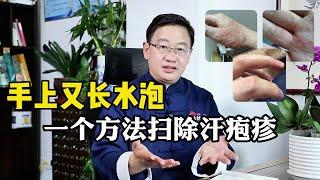 手上又长小水泡，一个方法横扫汗疱疹