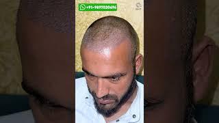 Youtuber Bilal Rajput Hair Transplant Progress #shorts#hairtransplant