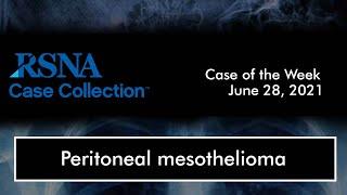 Case of the Week: Peritoneal Mesothelioma