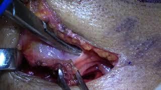 Submandibular gland excision