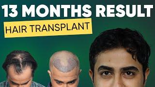 Hair Transplant in Mizoram | Best Results & Cost of Hair Transplant in Mizoram