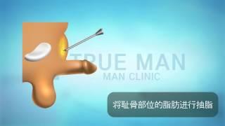 阴茎延长术, 生殖器延长  -  男性手术专科医院trueman