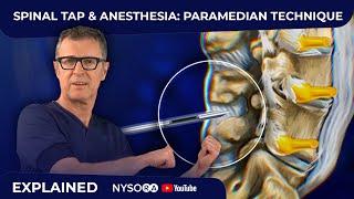 Spinal Tap - Anesthesia: Paramedian Technique - Crash course with Dr. Hadzic