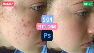 Easy skin retouching in another level for beginners only.. ( photoshop tutorial )