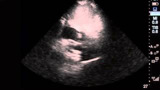 Post pericardiocentesis - subcostal 4 chamber