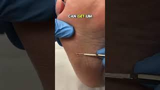 Painful corn removal from the foot by a podiatrist