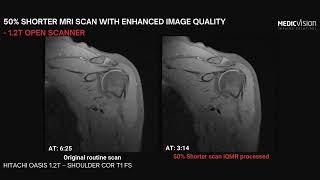 Enhance low-field MRI scanners: cut scan time by 50% while maintaining image quality