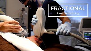 Pearl Fractional Laser Resurfacing | Anti-Aging Treatments