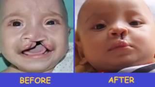 Global Smile Foundation( (GSF): Francisco's Beautiful Smile