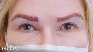 Eyebrow Transplants Restore Brows With Real Hair