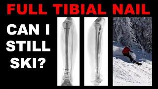 FULL TIBIAL NAIL  -  Can I still ski?  -  One year post-surgery.