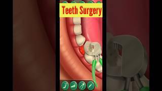 Teeth surgery 3D Animation #shortvideo #shorts #dental #3d