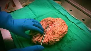 Cutting the Fresh Human Brain (With Narration)