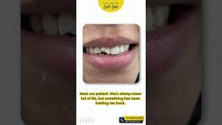 Porcelain Veneers| Teeth Restoration| Dr. Dipti's Smile Suite- Best Dental Clinic in Faridabad