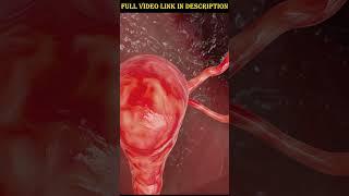 Female Sterilization: Tubectomy 3D Animation Explained | Medical Procedure Overview