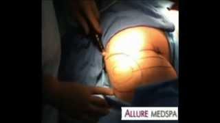 #VaserLiposuction | Ultrasonic, Ultrasound Liposuction Surgery @Alluremedspa (Mumbai, India)