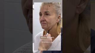 Хочется побыть еще молодой Фейслифтинг. Эндолоб. Доктор ТУМАКОВ ГЛЕБ ИГОРЕВИЧ