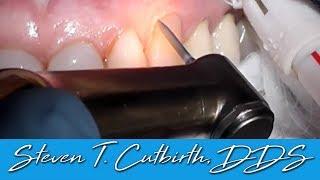 Composite Restoration of Gumline Decay - Dental Minute with Steven T. Cutbirth, DDS