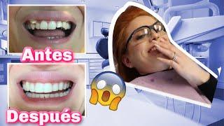 Me Quitan Los Brackets  | Increíbles resultados 