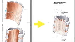 Management of Tracheobronchomalacia