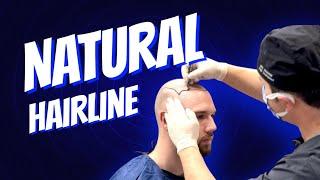 How to Achieve a Natural Hairline with a Hair Transplant ? - Dr. Resul Yaman Hair Clinic