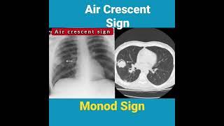 Air Crescent & Monod Sign - CXR